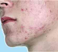 Kako liječiti acne vulgaris