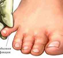 Kako liječiti atletsko stopalo? Simptomi koji prate bolesti.
