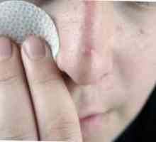 Kako liječiti akne na nosu, i zašto se pojavljuju?