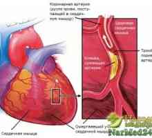 Kako za liječenje angine srce na tradicionalni način