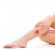 Kako liječiti rane na noge? Koji su uzroci bolesti?