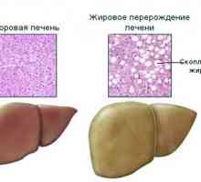 Kako liječiti proširene jetre?