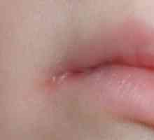 Kako liječiti perleches na usnama?