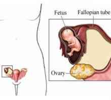 Kako prepoznati ectopic trudnoće? Simptomi koji se mogu identificirati u kući