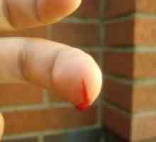 Kako zaustaviti krvarenje iz prsta