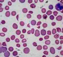 Uzroci niskog krvnog leukocita
