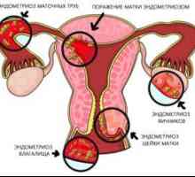 Kako uzeti Janine endometrioze