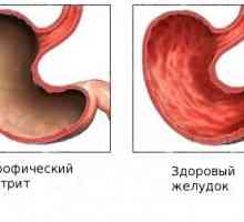 Kako je subatrophic gastritis?