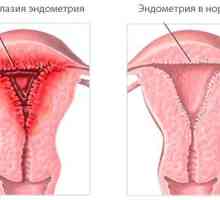 Kako provesti liječenje hiperplazije endometrija narodnih lijekova?