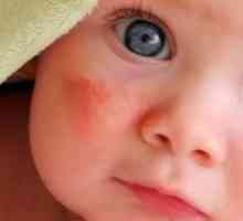 Kako izliječiti dijatezu u dojenčadi narodnih lijekova: 10 načina