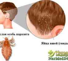 Kako liječiti Uši home lijekova