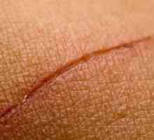Kako liječiti ožiljke kod kuće?