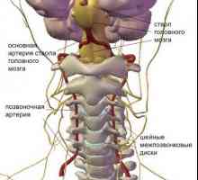 Kako živjeti sa sindromom vertebralne arterije
