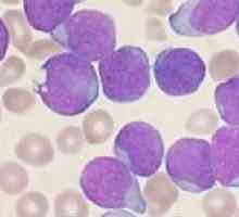 Simptomi raka krvi u odraslih i djece