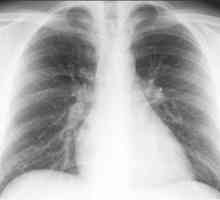 Koji su prvi znakovi bronhitisa u odraslih? Dijagnoza kronične oblike bolesti.
