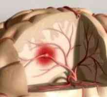 Koji su rani znakovi i simptomi manjeg moždanog udara u žena i muškaraca? Upozorenje opasne…