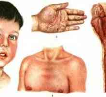 Koji su simptomi šarlaha u djeteta? Razmatranje simptoma.