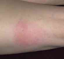 Koji simptomi se javljaju kada alergije na ubode insekata