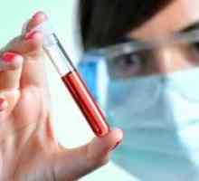 Što je stopa bilirubina u krvi djece, žena i muškaraca? Biokemijska analiza krvi.