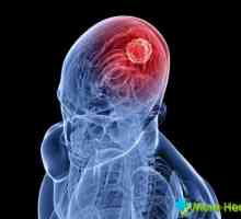 Koji su prvi znakovi raka mozga u odraslih i djece