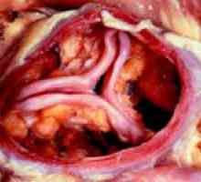 Kalcifikaciju aortalni ventil