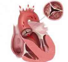 Kalcifikaciju srca i krvnih žila: izgled, osobine, dijagnoza, liječenje