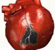 Kardiogeni šok