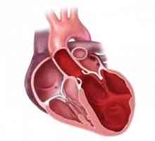 Kardiomiopatija u djece i odraslih: izgledu, obliku, simptomi, kako se postupa
