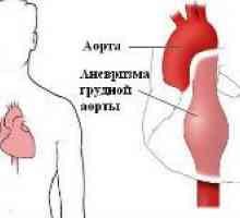 Klinički znakovi aneurizme aorte