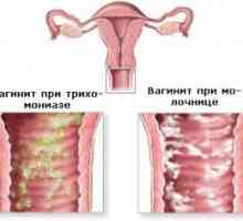 Coleitis (vaginitisa) u muškaraca i žena
