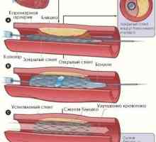 Koronarna angiografija: što je to, kada se provodi, indikacije i kontraindikacije