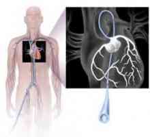 Koronarnih srčanih žila: kako svjedoče, posljedice