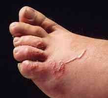 Kože toxocariasis - simptom bolesti i liječenje