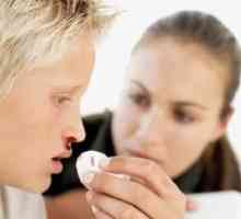 Krvarenje iz nosa - saznati uzrok i naučiti brzo da se zaustavi