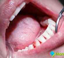 Krvarenje desni prilikom pranja zubi: koji su razlozi