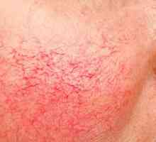 Rosacea kože: uzroci, liječenje