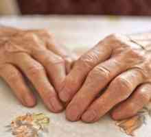 Liječenje artritisa ruku zglobova