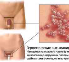 Genitalni herpes liječenje raznih narodnih lijekova