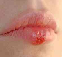 Liječenje herpesa na usnama