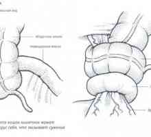 Liječenje i djelovanje na intestinalni nekroze