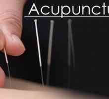 Liječenje kineske akupunkture