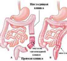 Liječenje polipa u debelom crijevu sigmoidalne