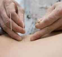 Liječenje akupunktura