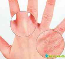 Liječenje seboroičnog dermatitisa: uzroci