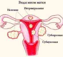 Liječenje mioma maternice submucous