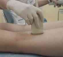 Liječenje tromboflebitisa donjih udova narodnih lijekova