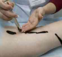 Liječenje varikoze pijavice (girudoterapija)