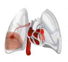 Plućna hemoragija: uzroci, simptomi, oblika, liječenje