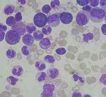 Leukociti u mokraći - što to znači? Uzroci bijelih krvnih stanica u mokraći.