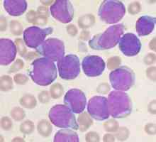Leukemije (leukemija): vrste, simptomi, prognoza, liječenje, uzroci